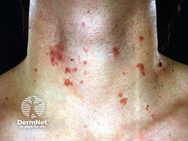 Acute string trimmers’ dermatitis