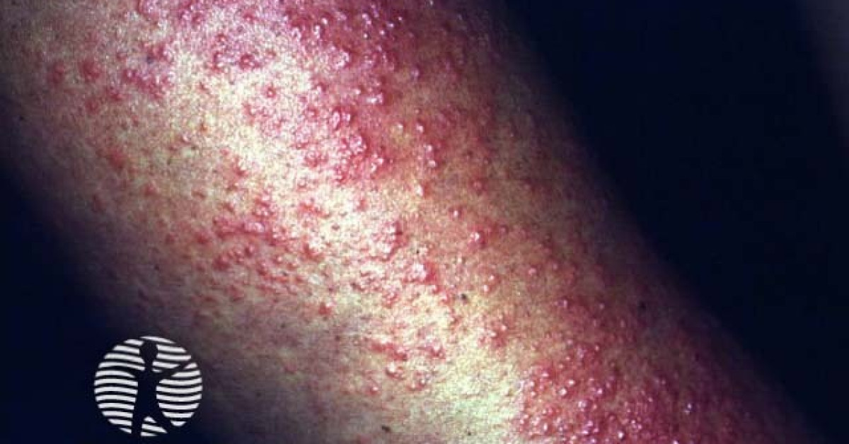 Polymorphic light eruption image