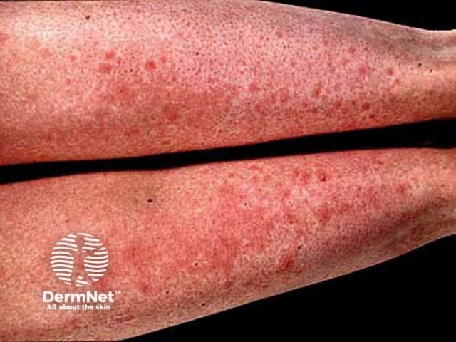 Erythematous macules and plaques