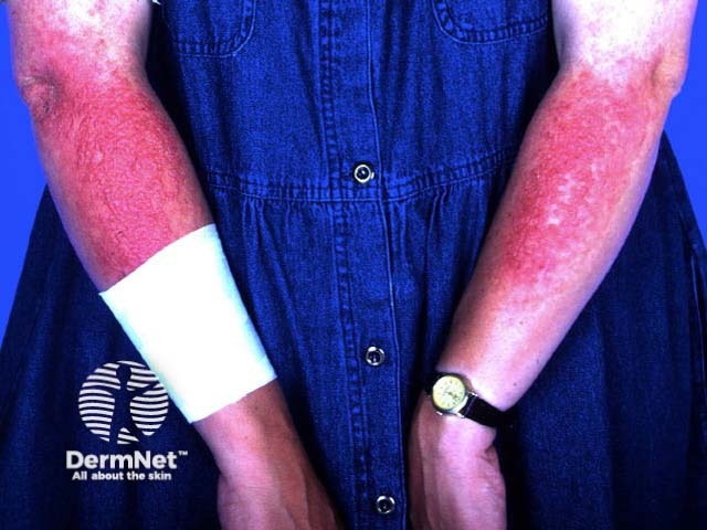 Vesicular eruption (sunscreen)