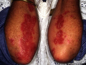 Effect of PUVA on psoriasis