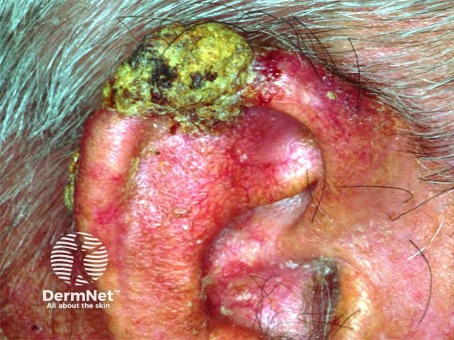 Squamous cell carcinoma