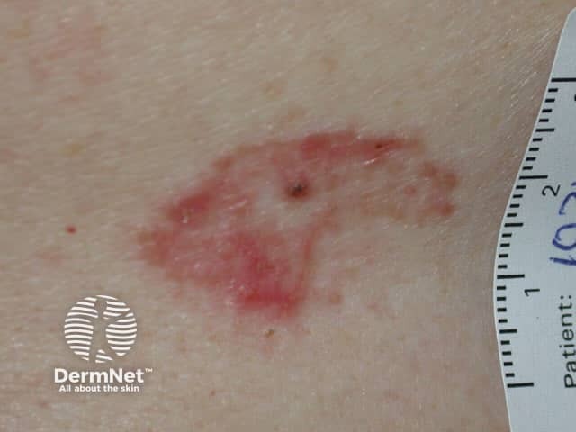 Superficial basal cell carcinoma