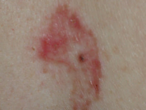 Superficial basal cell carcinoma