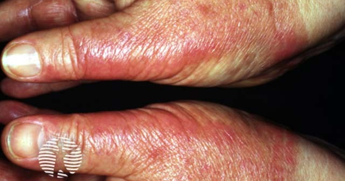 Phototoxic erythema from topical PUVA image