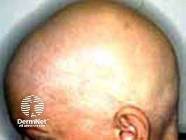 Total alopecia (from chemotherapy)