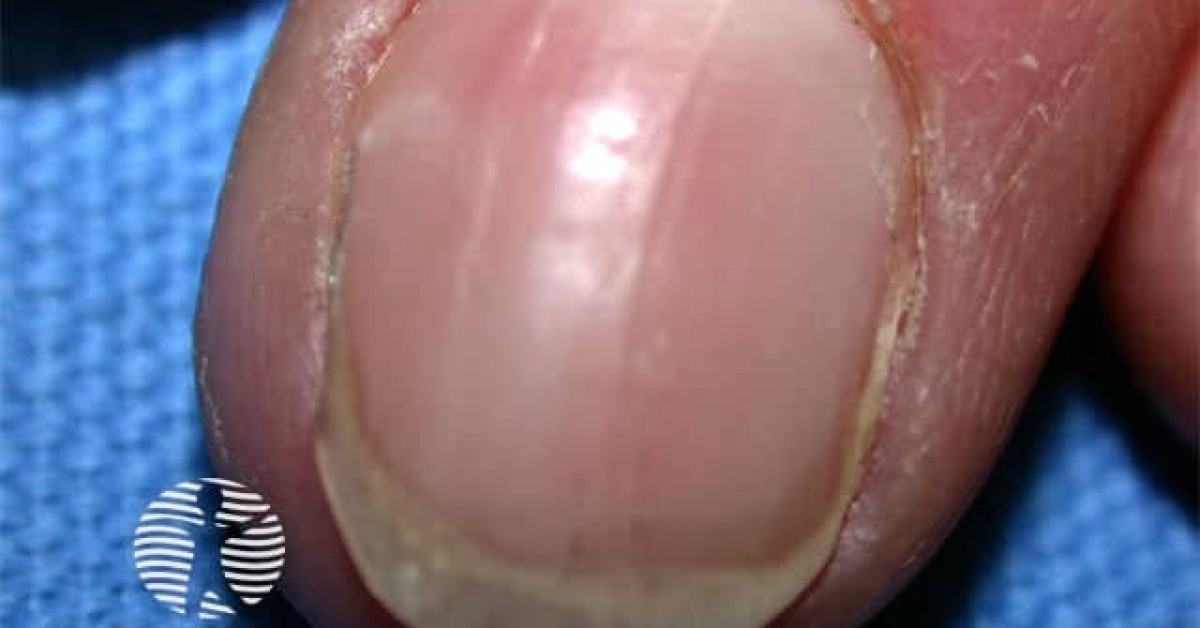 DermNet® - Curved nail image