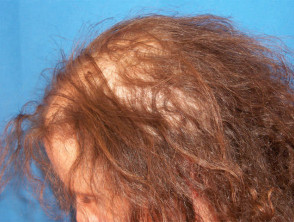Diffuse alopecia areata