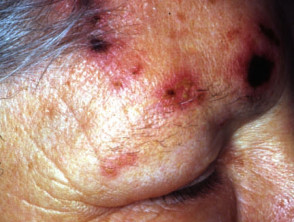 Herpes zoster ophthalmicus