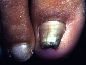 Pincer nail