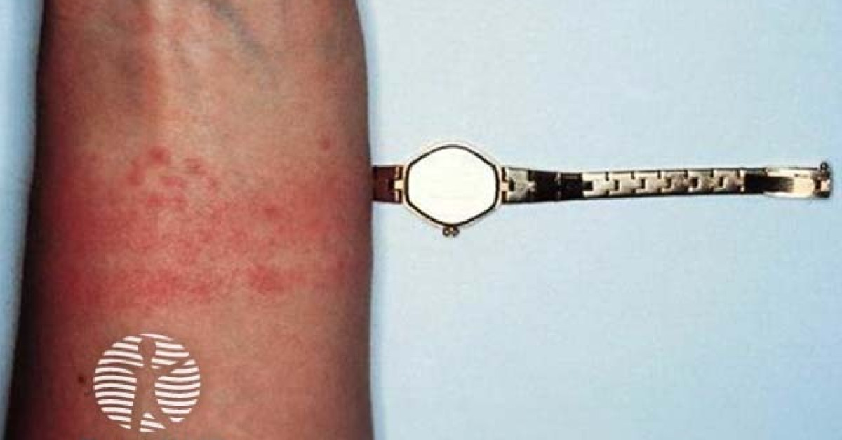 Speed Stick Rash 006a image