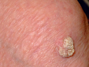 Malignant skin lesions – 10 cases | DermNet NZ