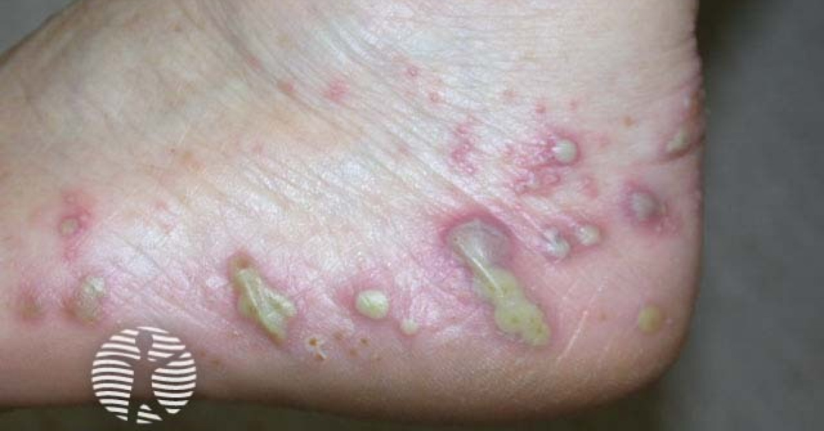 Dermnet Foot Rash case7 image