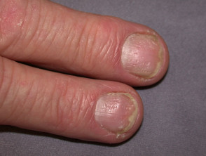 Nail abnormalities – 10 cases | DermNet