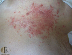 intertrigo candida syndrome metabolic cutaneous cases fungal signs case skin dermnet