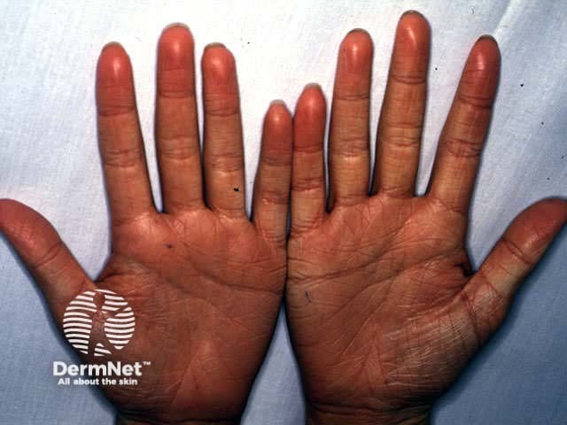 Hyperlinear palms in ichthyosis vulgaris