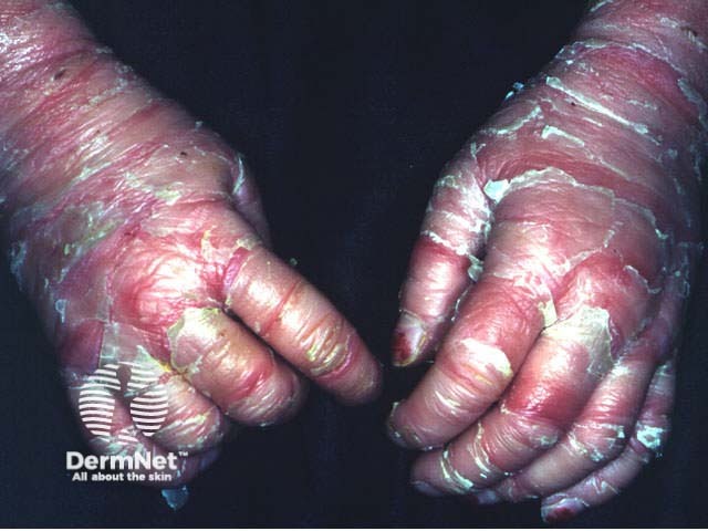 Bullous ichthyosiform erythroderma