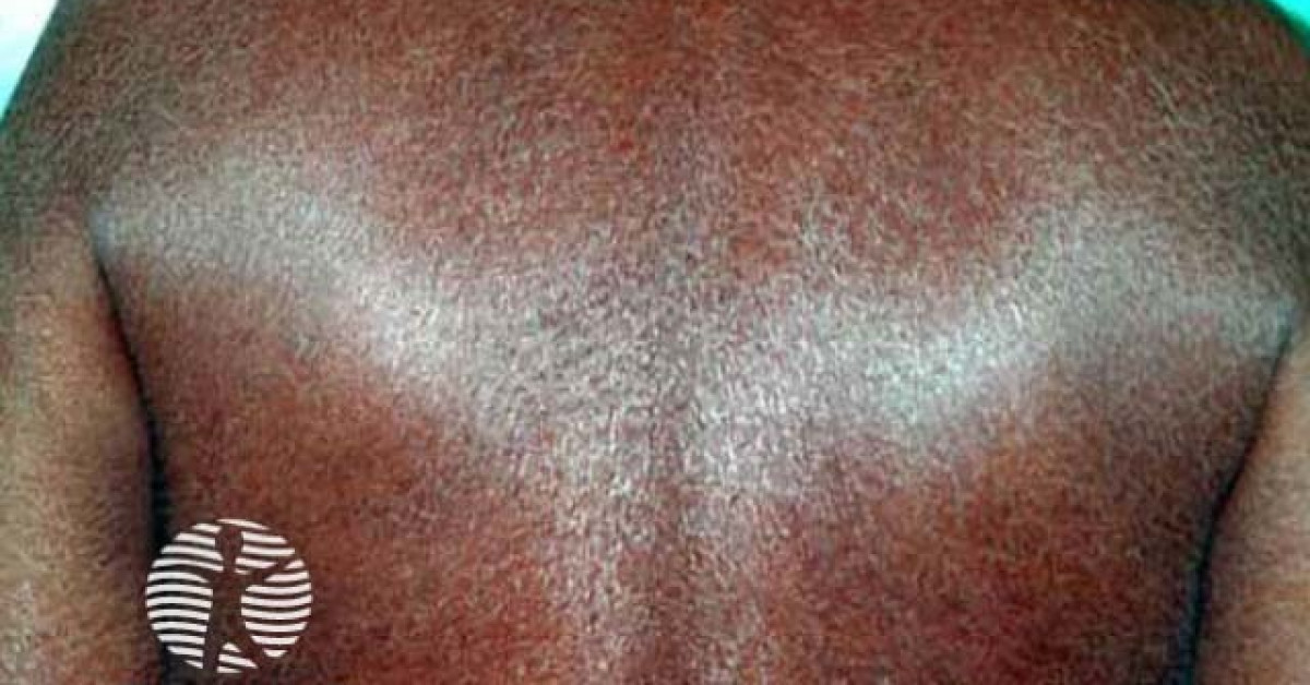 Acquired ichthyosis in kava drinker image