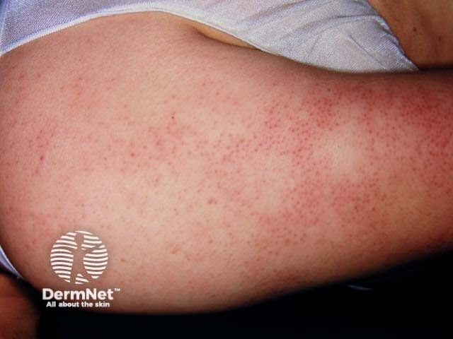 Keratosis rubra pilaris