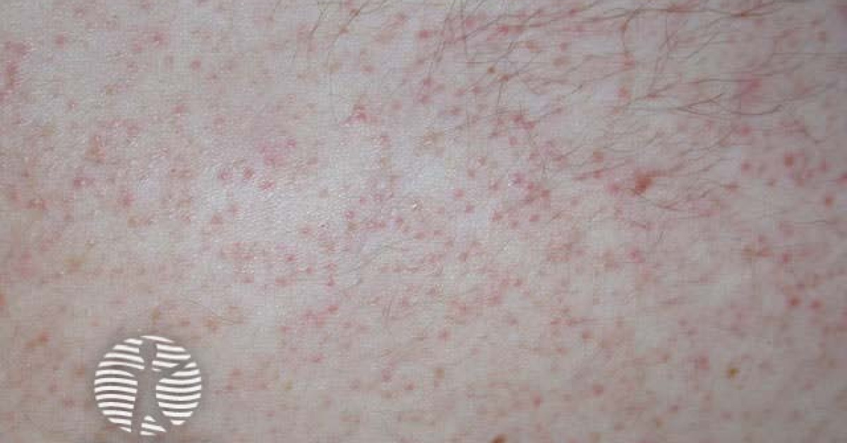 Keratosis pilaris image