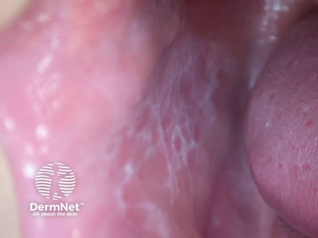 Lacy-pattern in buccal mucosa