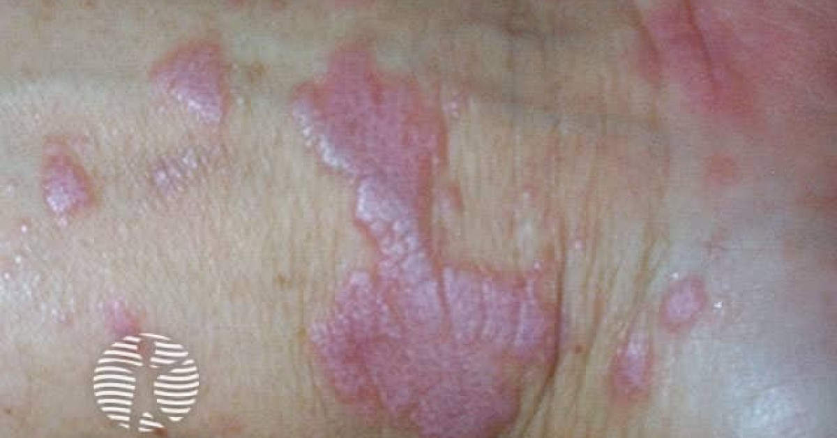 Chronic Lp Rash Lichen planus image