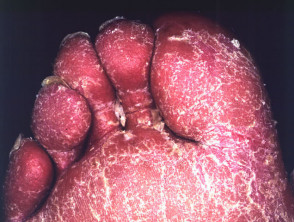 Erythrodermic psoriasis
