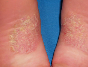 Chronic plaques of psoriasis