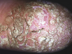 Chronic plaques of psoriasis