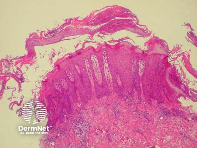 Thick stratum corneum and projections of epidermis