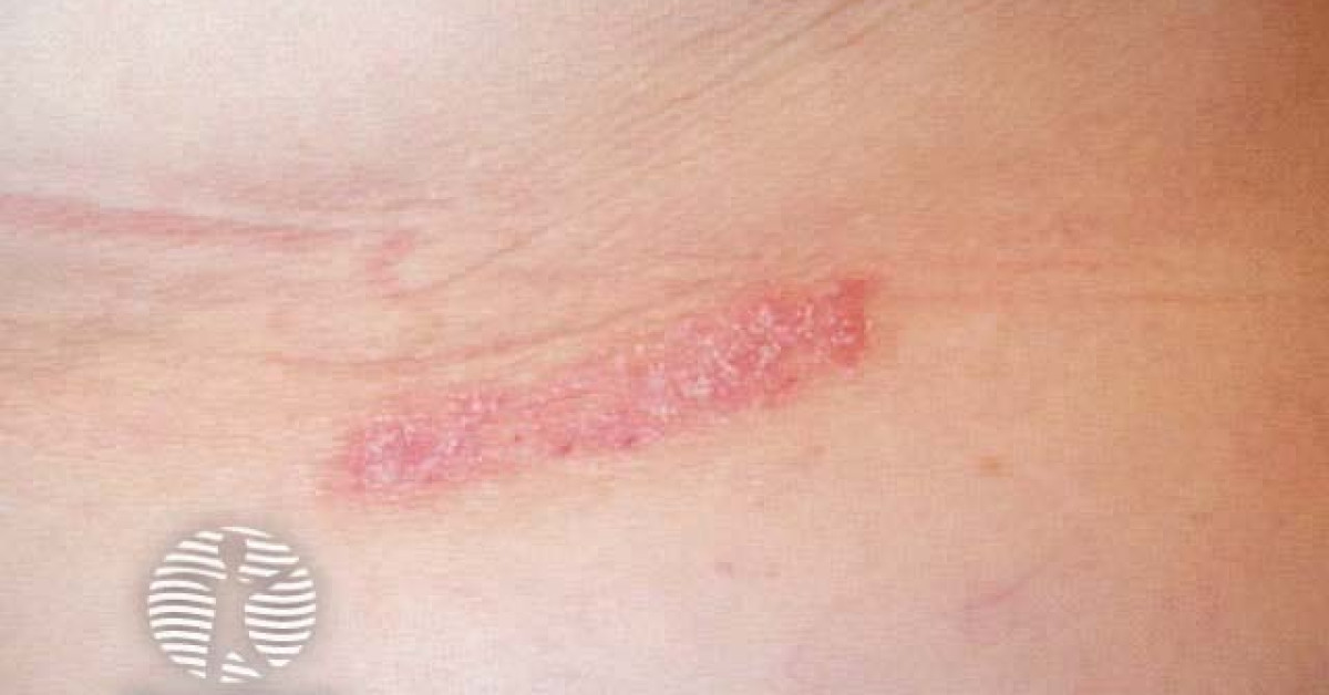 Koebnerised psoriasis image