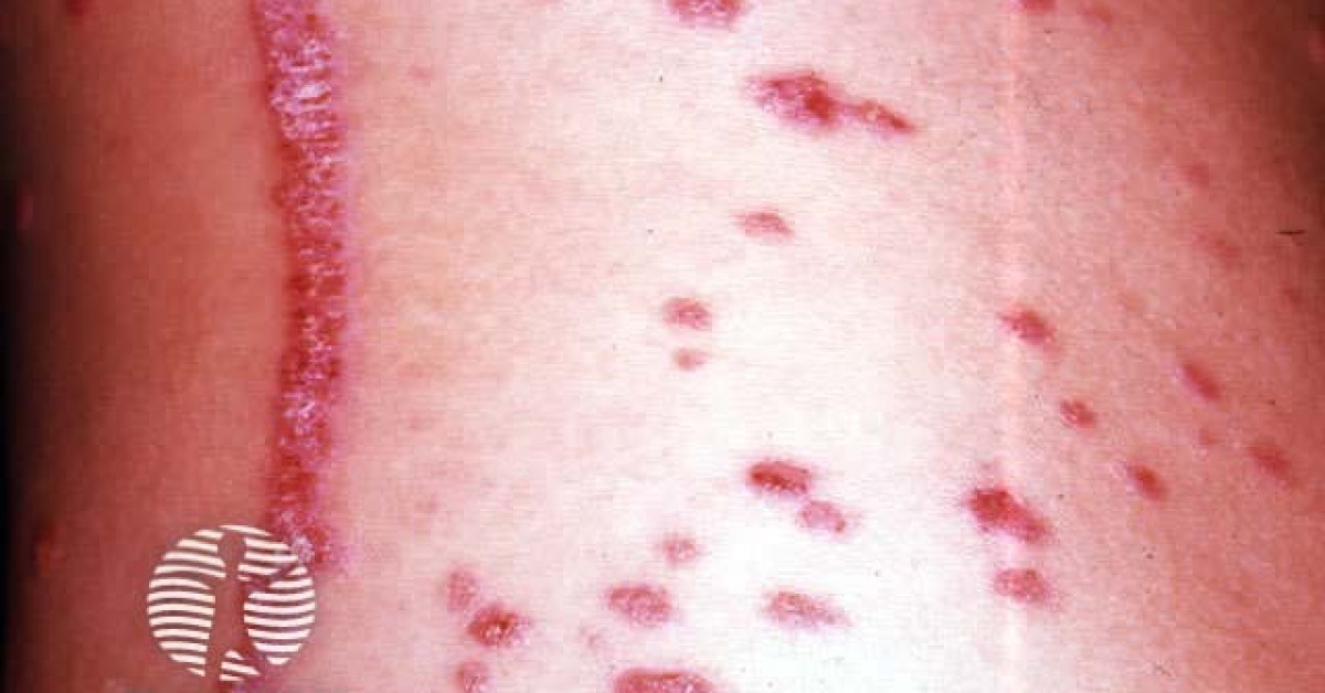 Psoriasis image