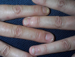 What's the Difference Between Nail Fungus and Nail Psoriasis?