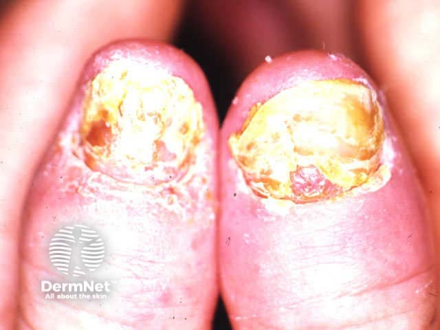 Nail psoriasis