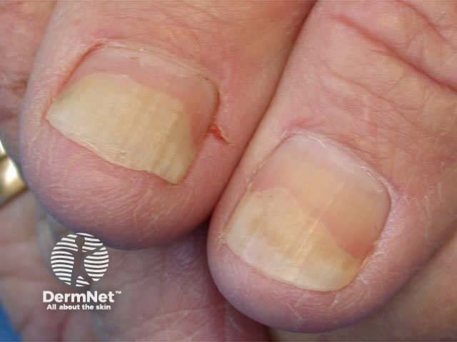 Nail psoriasis