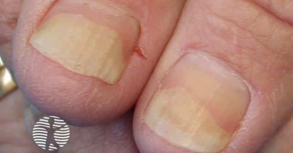 DermNet® - Nail psoriasis image