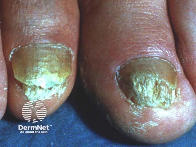 Nail psoriasis