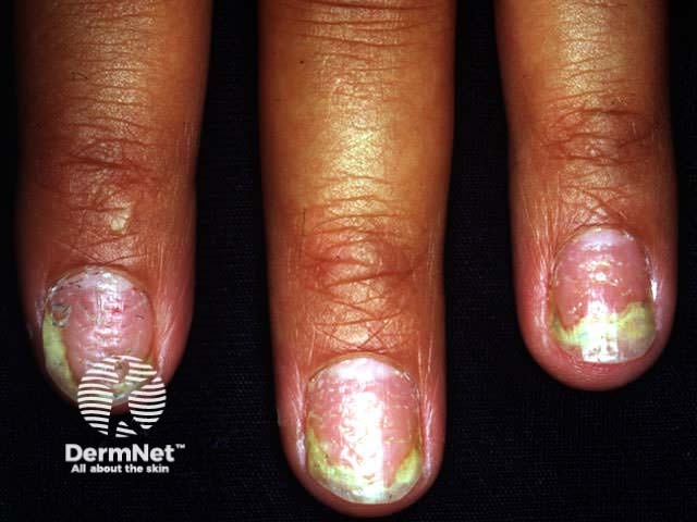 Nail psoriasis