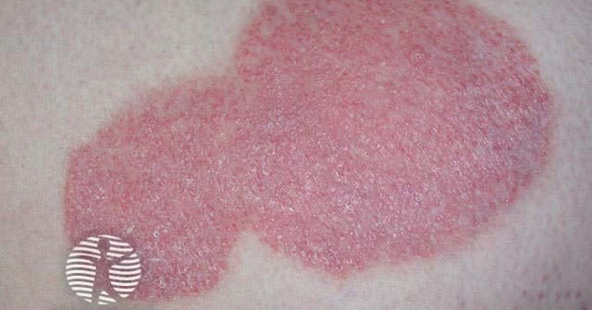 Psoriasis Image