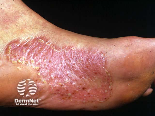 Localised pustular psoriasis