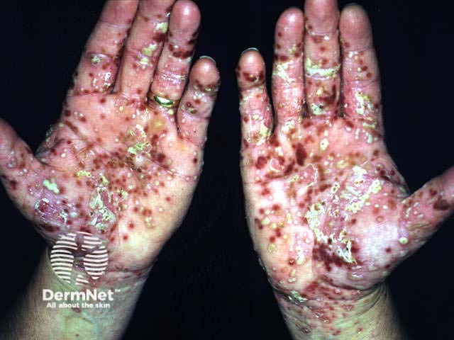 Localised pustular psoriasis