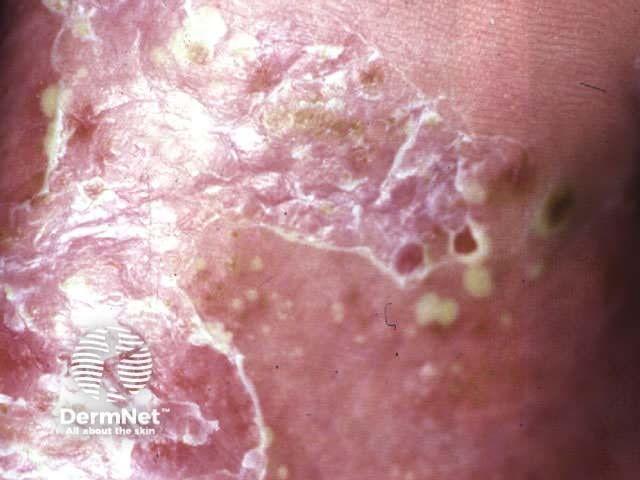 Localised pustular psoriasis