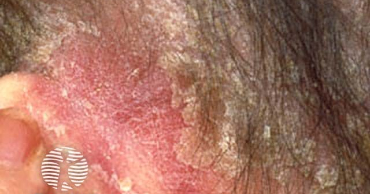 Psoriasis image