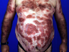 Steroid atrophy