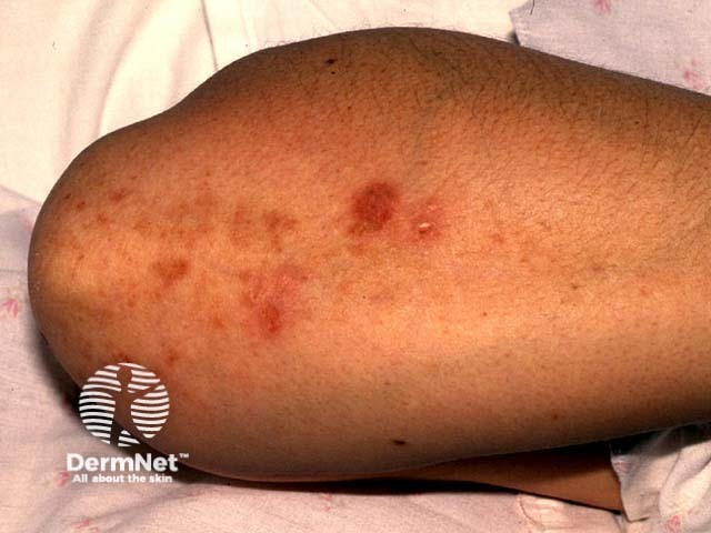 Dermatitis herpetiformis