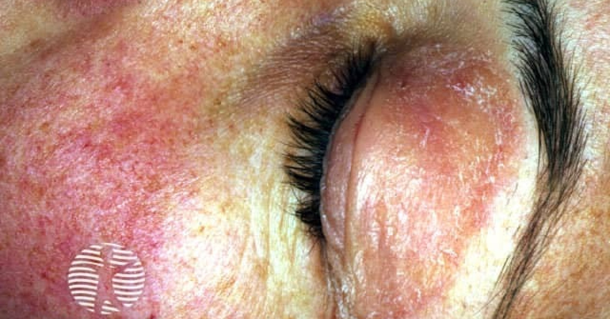 Dermatomyositis. Heliotrope rash image