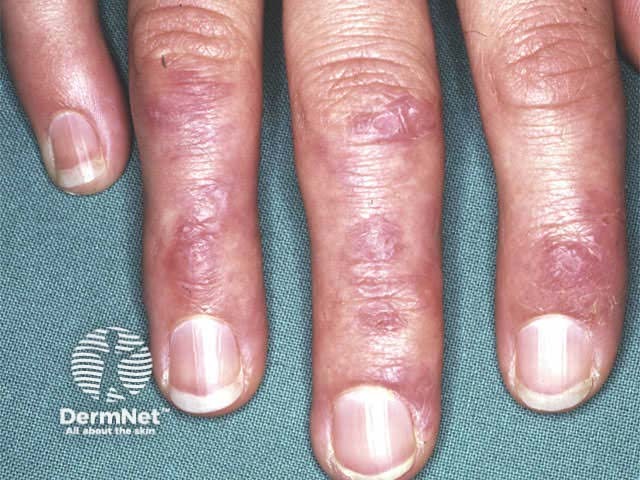 Severe dermatomyositis of the hands unresponsive to steroids and methotrexate; rituximab is one of several therapeutic options