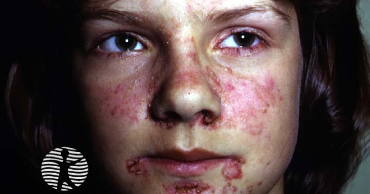 DermNet® - Discoid lupus erythematosus image