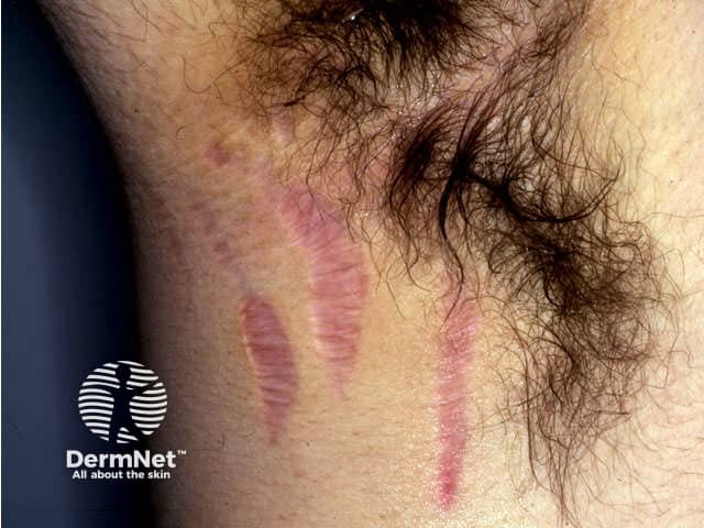 Striae due to systemic steroids