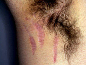Striae due to systemic steroids